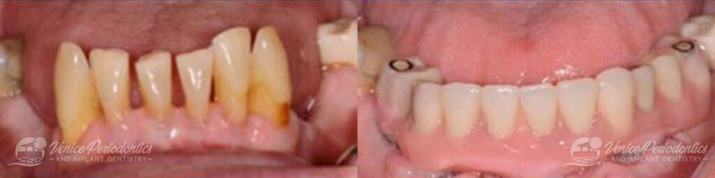 multipleteethimplants_patient1a