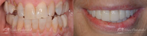 0007_dental-implants_patient1a