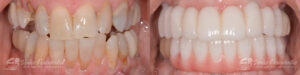 0008_dental-implants_patient1b